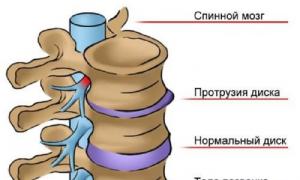 Protrúzia hrudnej chrbtice: príznaky, liečba a prevencia Medikamentózna liečba protrúzie hrudnej chrbtice